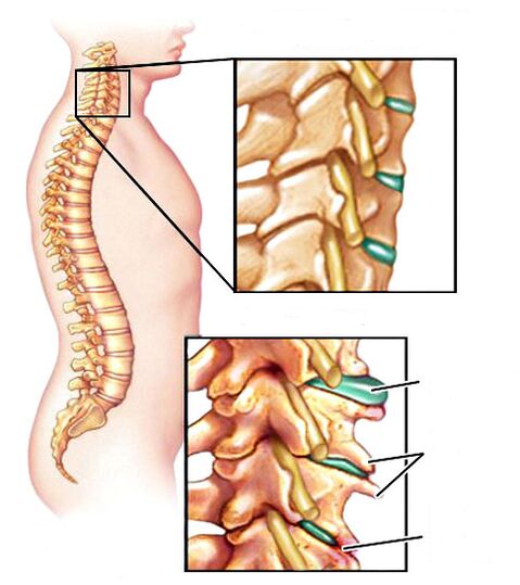 Kā izskatās osteohondroze