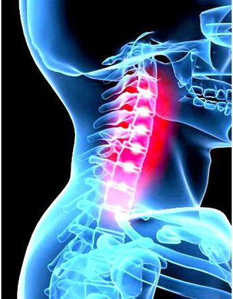Osteohondrozes klīniskais attēls